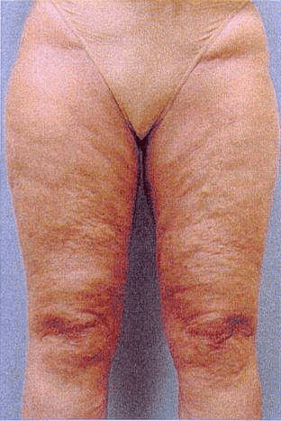 A woman 's legs with very large, wrinkled skin.