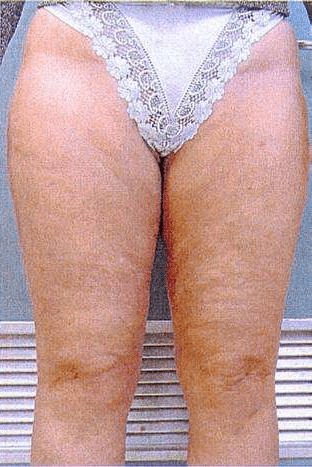 A woman 's legs with no visible underwear on.