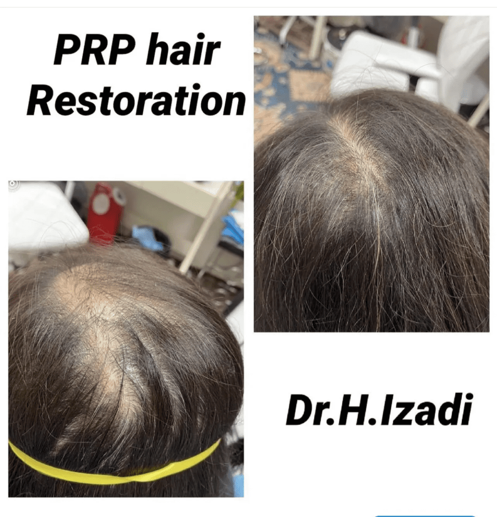 A woman 's hair is shown before and after prp.