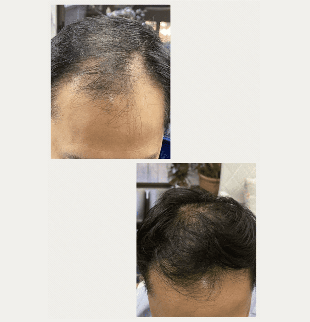 A before and after photo of a man 's hair.