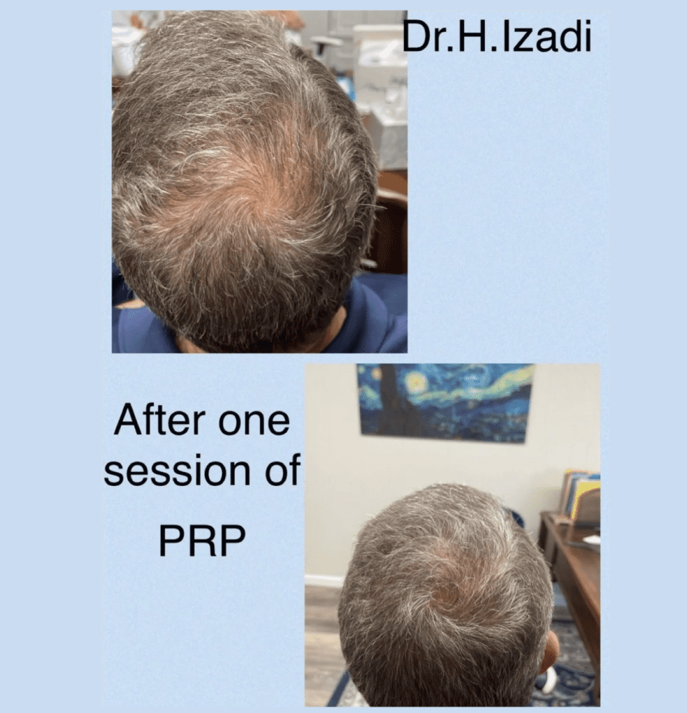 A man 's head with hair loss and before and after prp treatment.