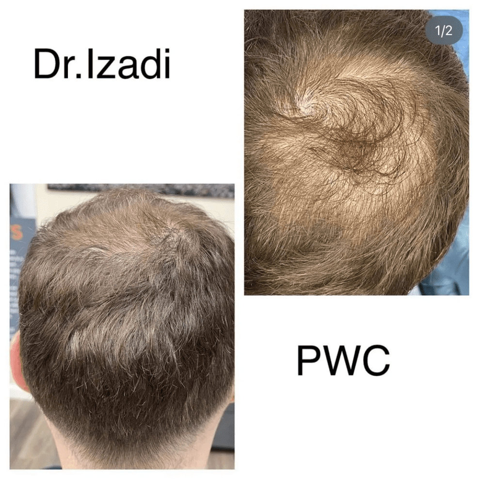 A man 's head with hair loss and the same hair type.