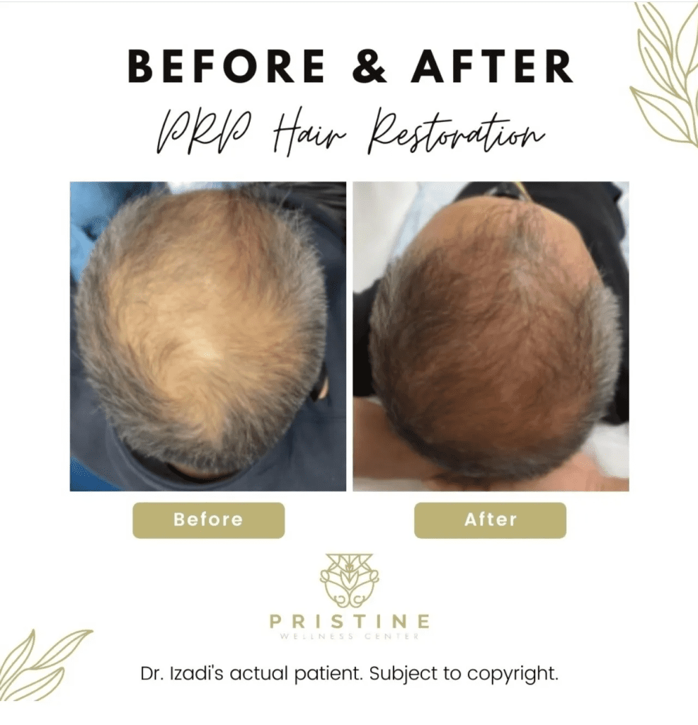 A before and after picture of a man 's hair restoration.