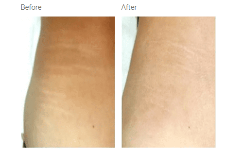 A before and after picture of the skin on someone 's arm.