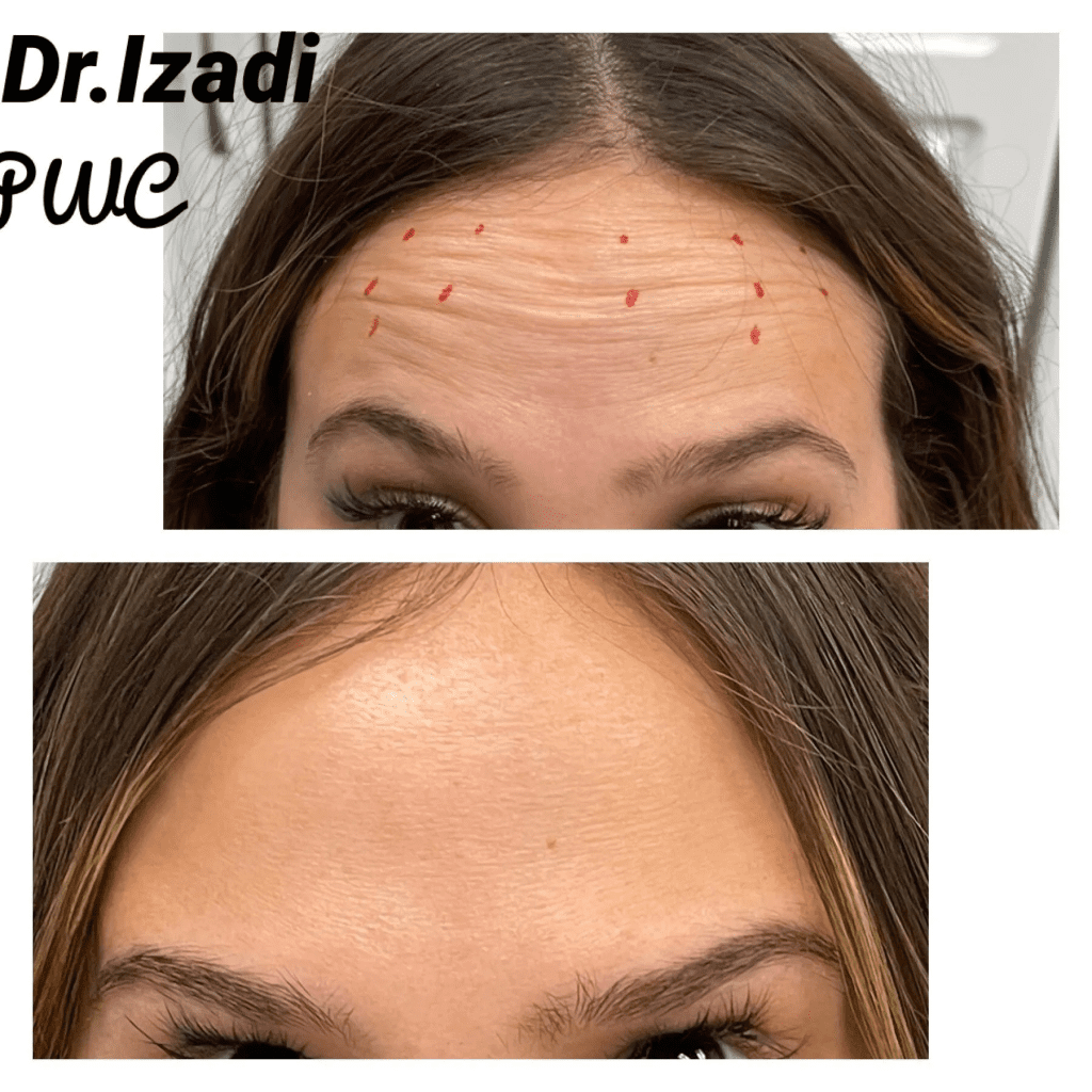 A woman before and after botox treatment.