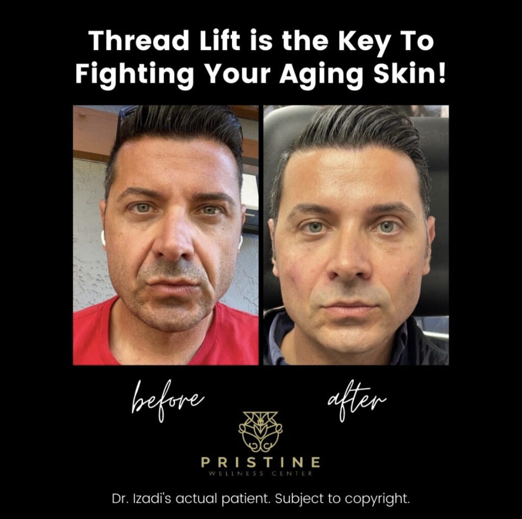 Thread lift is the key to fighting your aging skin