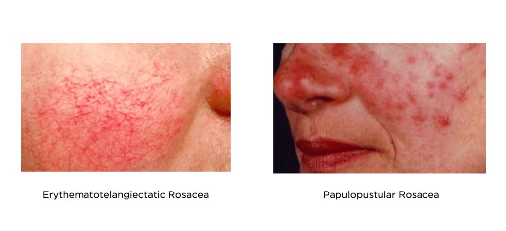 Erythema keratitis and erythema psoriasis.