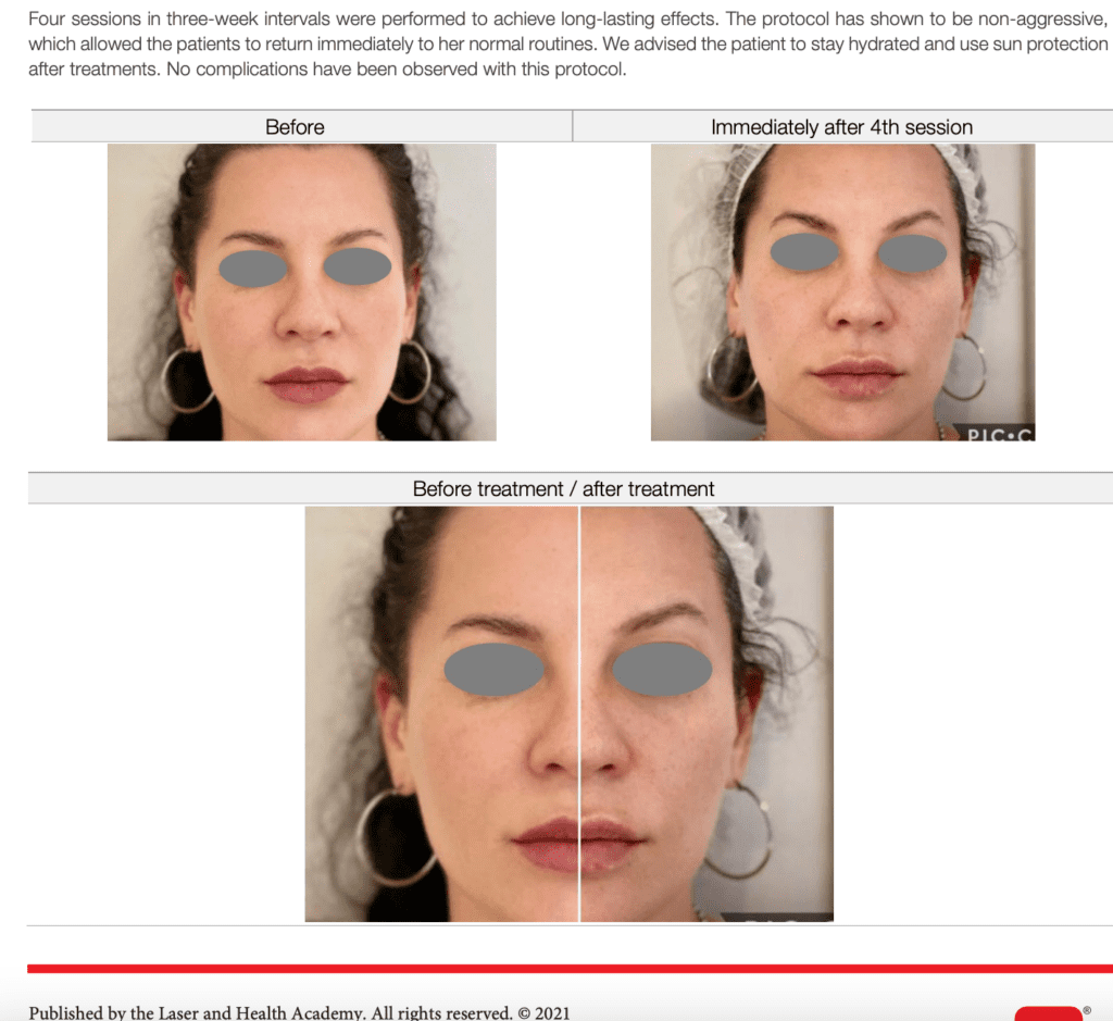 A woman's face is shown before and after treatment.