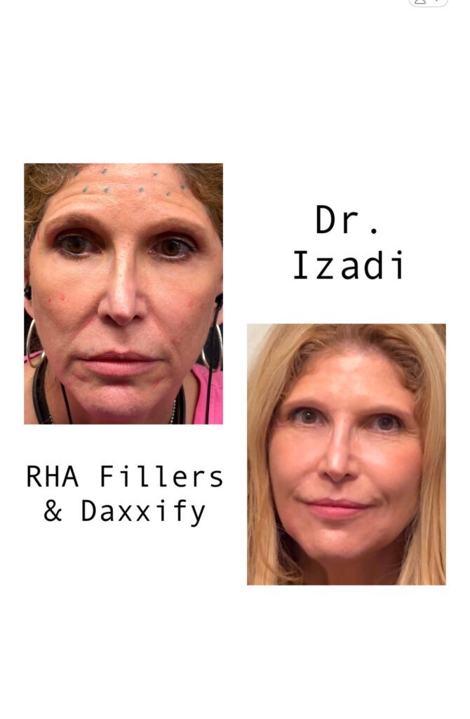 RHA Filler before and after Daxxify