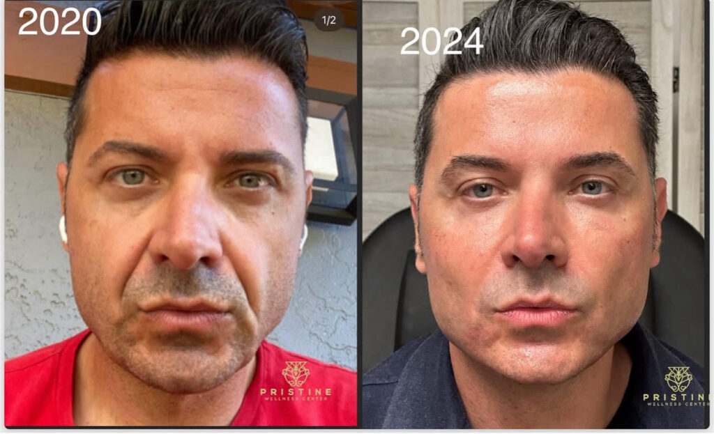 before and after anti-aging