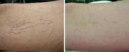 Example of spider veins before and after treatment. Not an actual patient of Dr. Izadi. Image by Fotona.com