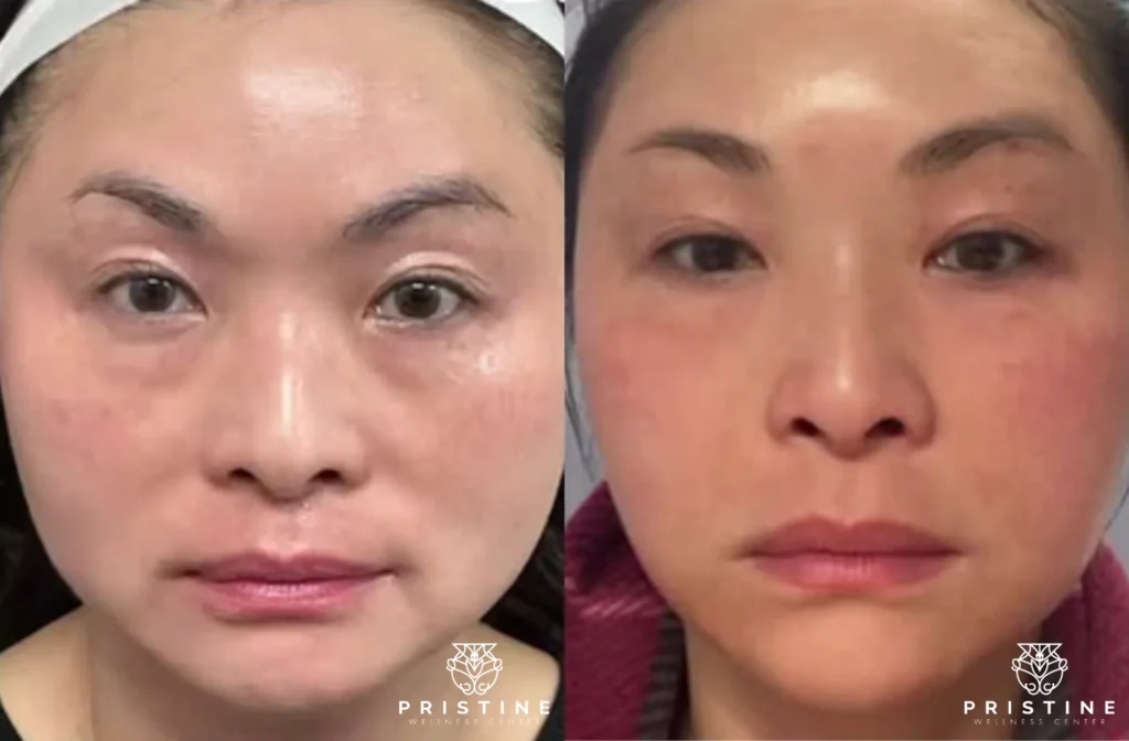 Before and after facial rejuvenation with Fotona laser treatment, showcasing improved skin texture and lifted