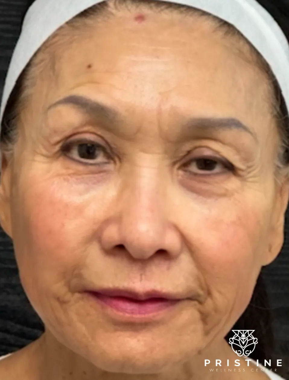 Before and after photo of non-surgical facelift results, demonstrating skin tightening and rejuvenation.