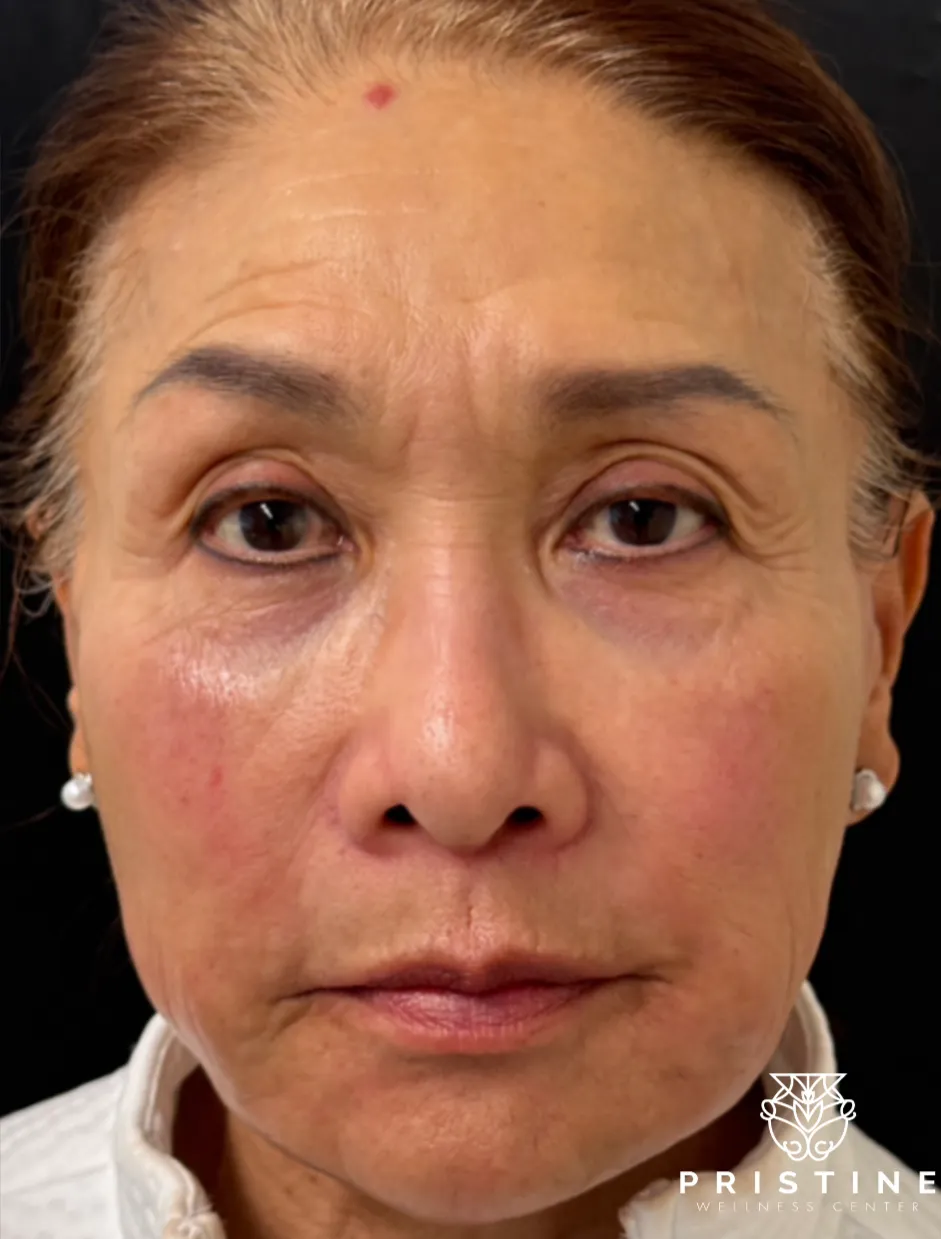 Woman's before photo showcasing non-surgical facelift results, demonstrating skin tightening and rejuvenation.