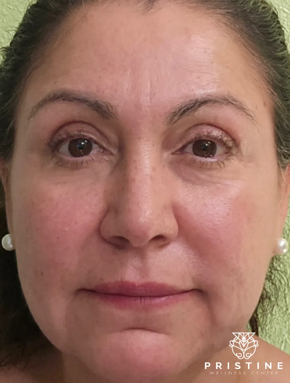 Before and after photo showcasing non-surgical facelift results and skin rejuvenation.