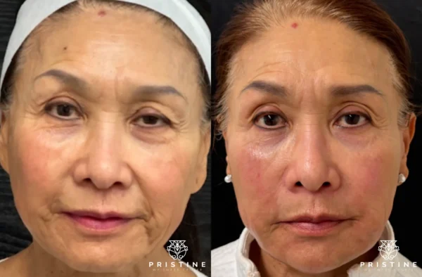 Before and after images showcasing non-surgical facelift results at Pristine Wellness Center.