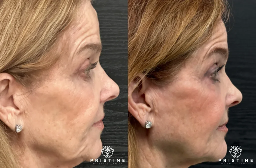 Before and after image showcasing non-surgical facelift results and skin tightening with Pristine Wellness Center.