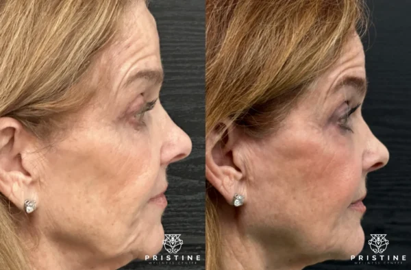 Before and after image showcasing non-surgical facelift results and skin tightening with Pristine Wellness Center.