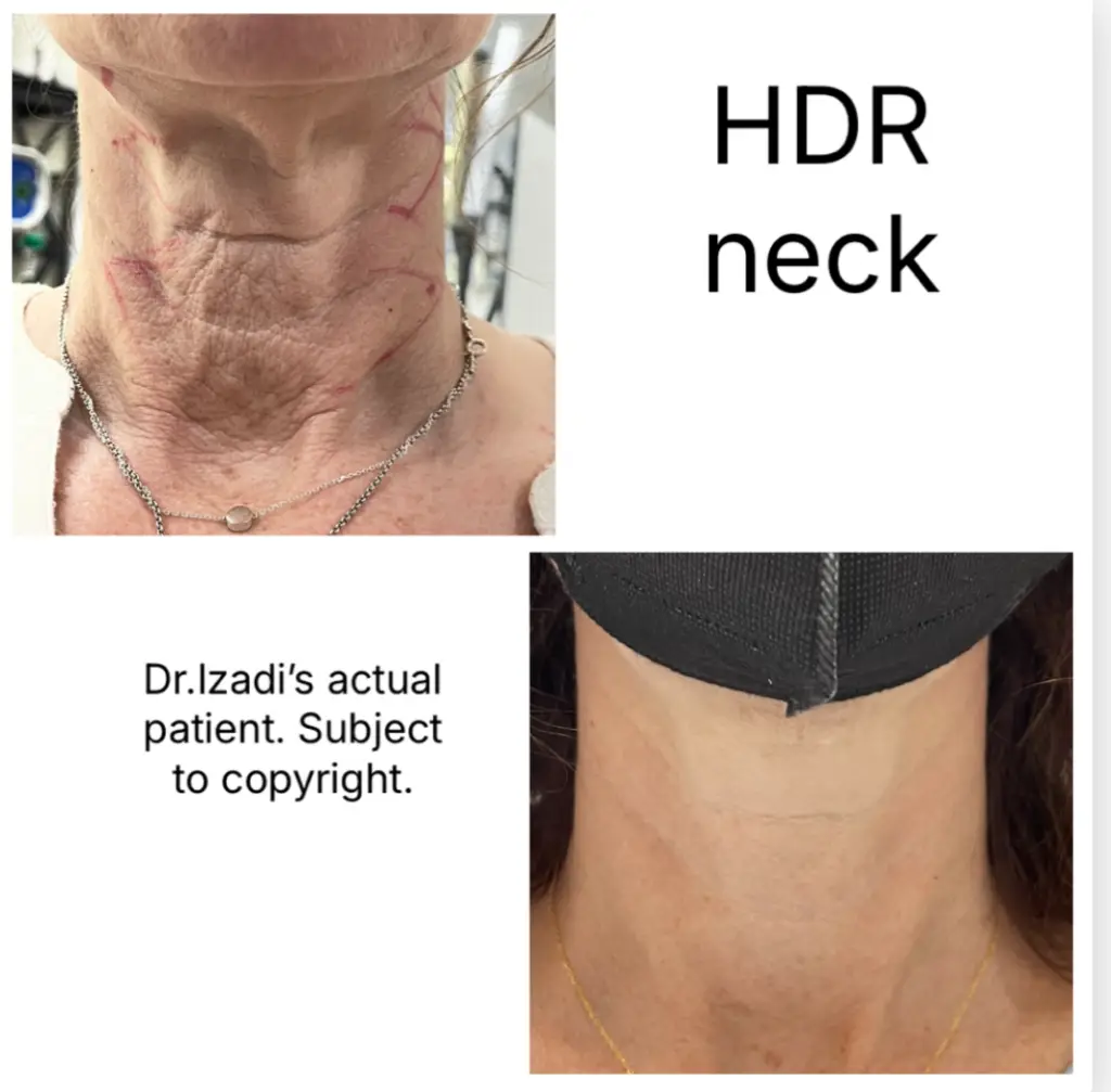 Neck rejuvenation results &ndash; actual patient of Dr. Izadi