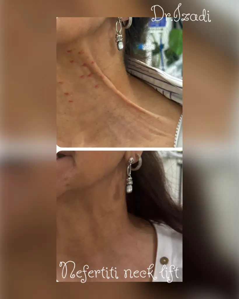 Neck rejuvenation results &ndash; actual patient of Dr. Izadi