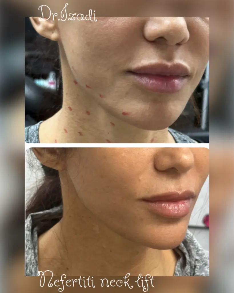 Neck rejuvenation results &ndash; actual patient of Dr. Izadi