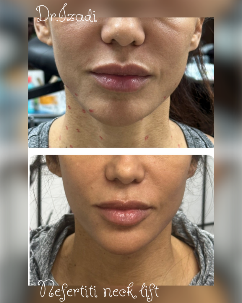 Improved jaw line definition after Neck rejuvenation results &ndash; actual patient of Dr. Izadi